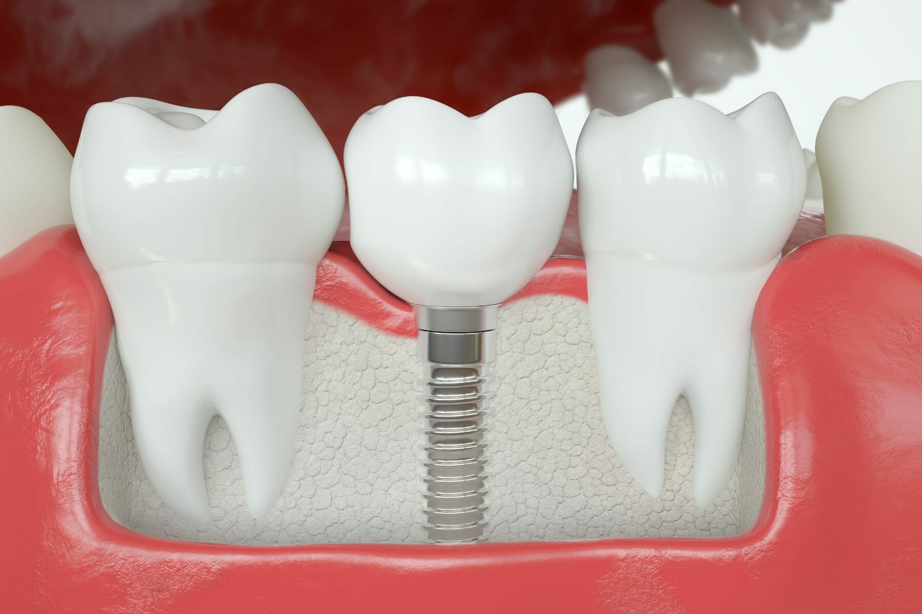 Dental Crown Vs Dental Implant 