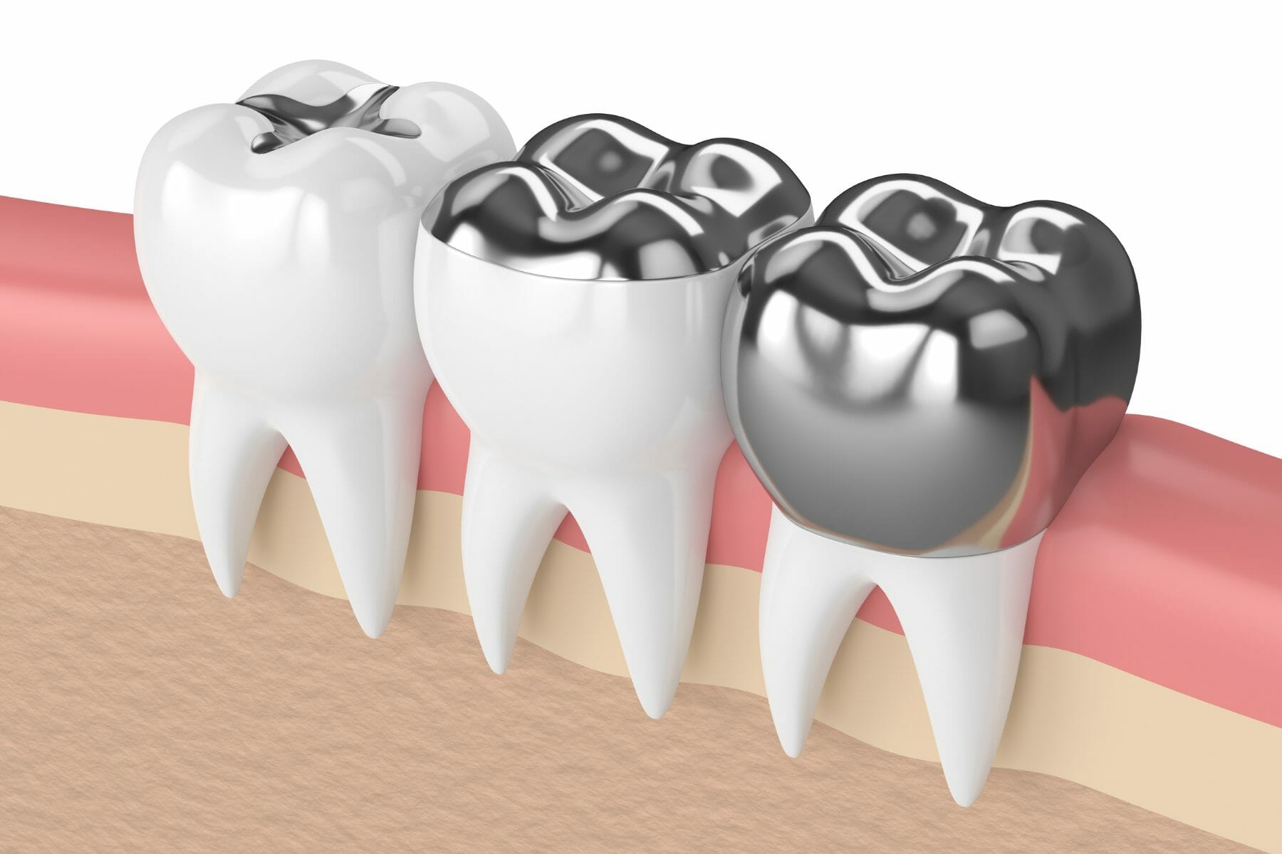 Dr Denti Tooth Fill, Dental Hole Repair Kit, Temporary Filling 10 Fillings