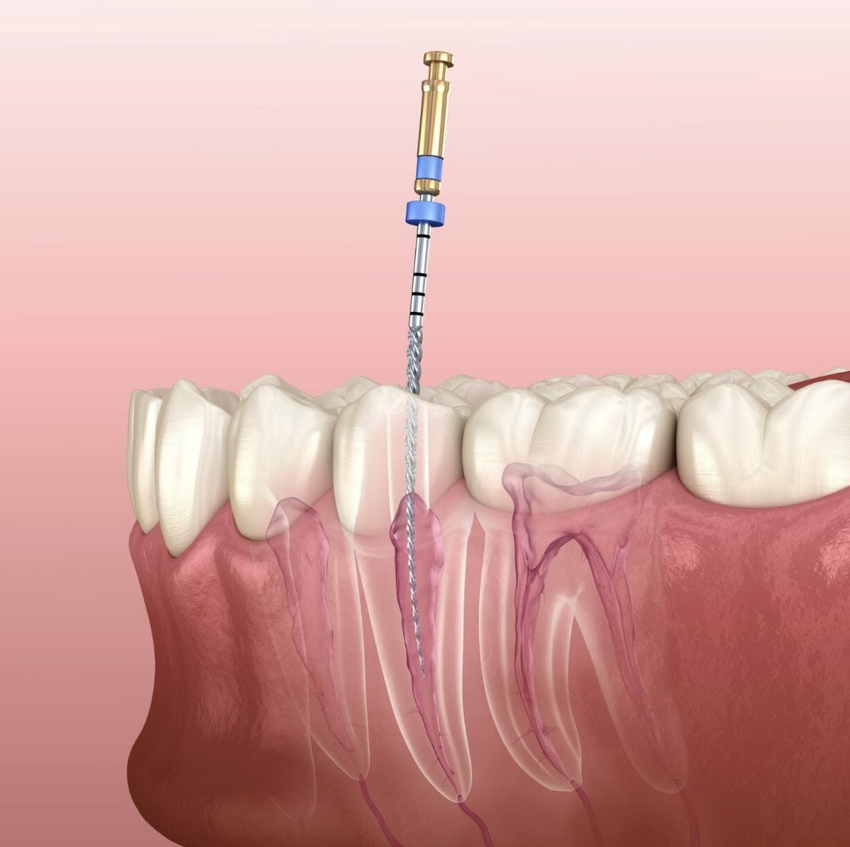 the-benefits-of-a-root-canal